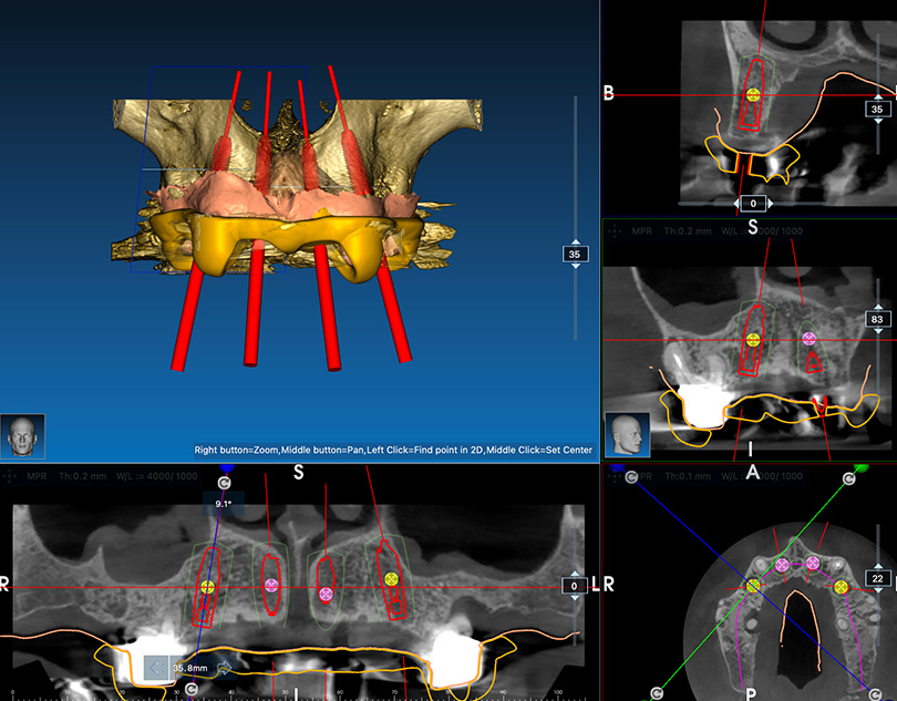 3D-Implantatplanung / -navigation