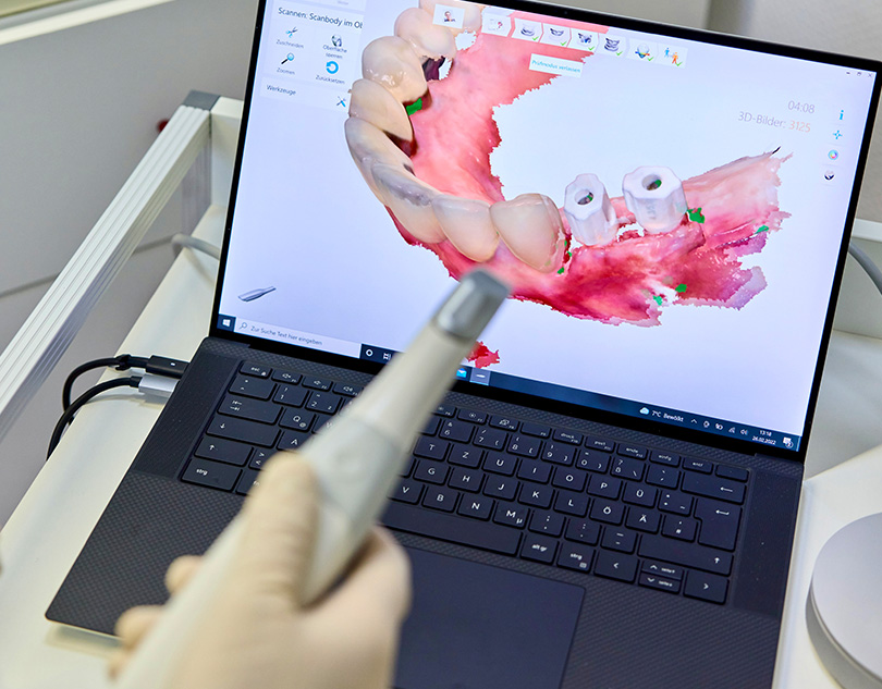 Intraoralscanner